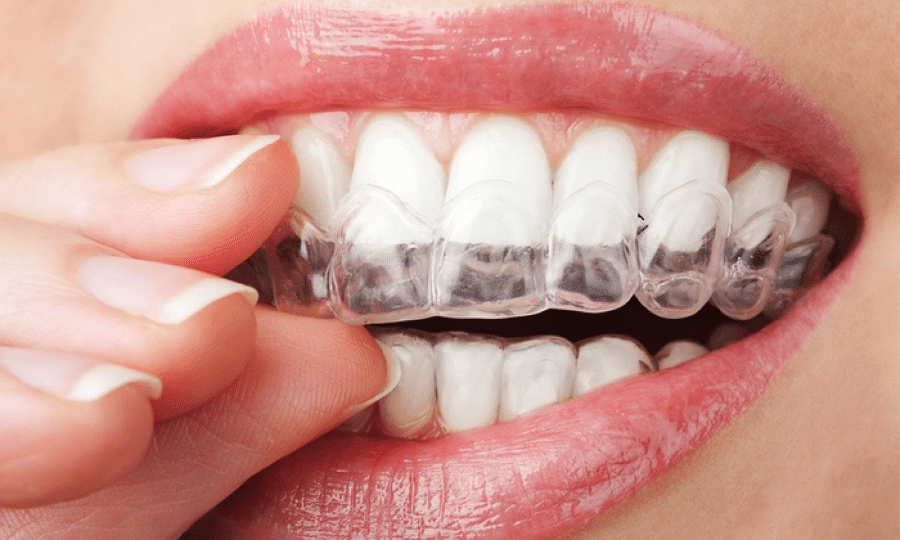 Smile Confidently With Spark Aligners Spark Aligners in Beaufort. CO. Professional orthodontic services for all ages. Orthodontist in Beaufort, SC 29902. Call:843-379-9200.