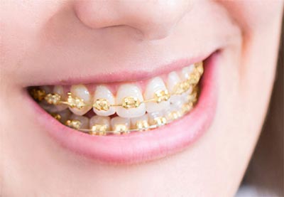 gold braces Coastal Orthodontics Orthodontist in Beaufort, SC